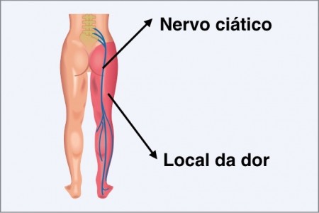Sintomas e tratamento do nervo ciático inflamado - Dica de Saúde